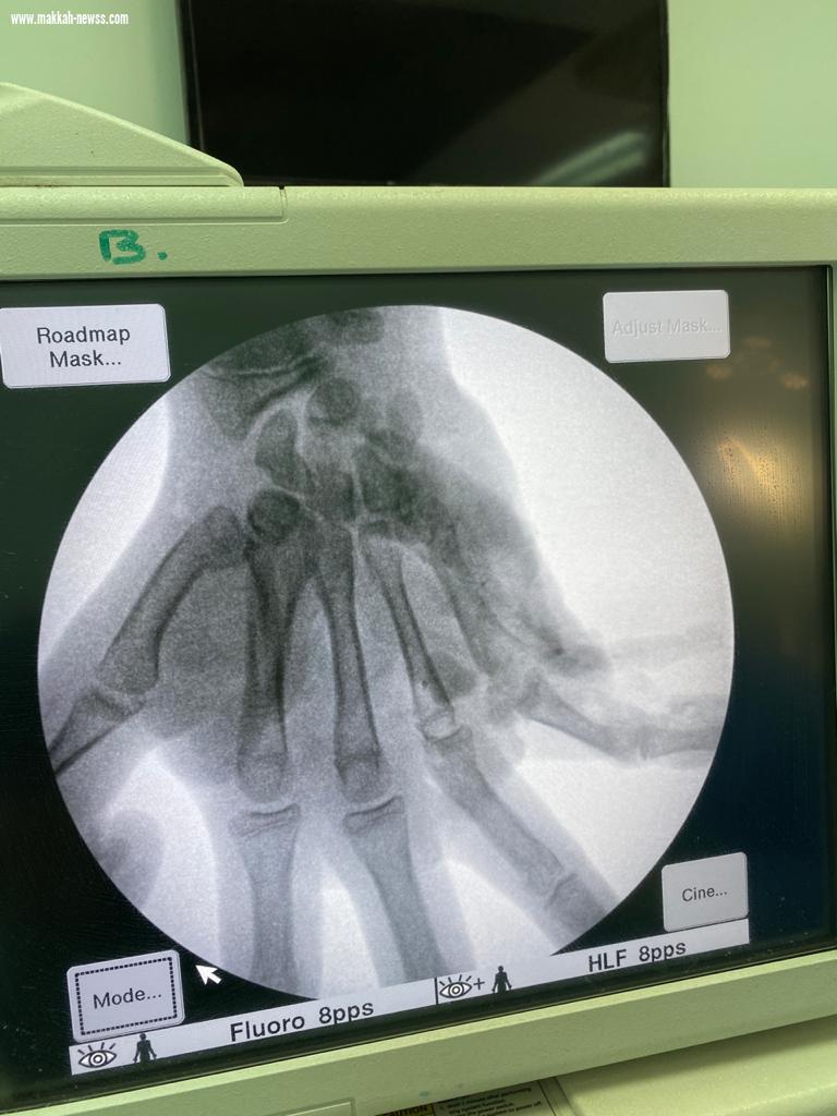 عملية ترميم لإعادة يد  متهتكة لمصاب في حادث مروري بمستشفى المؤسس بجدة