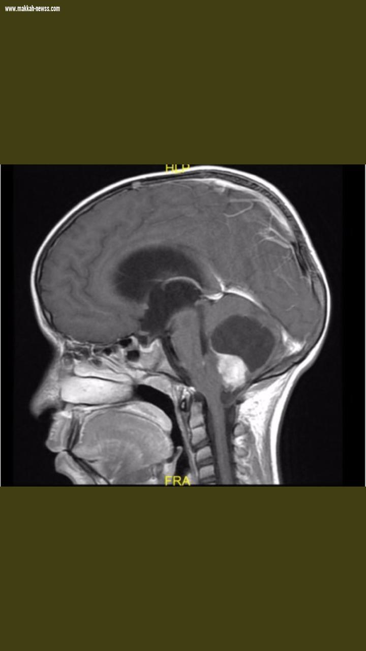 بعد نجاح أطباء شرق جدة في إستئصال الورم من مخه  طفل السابعة يعود لمدرسته سالماً